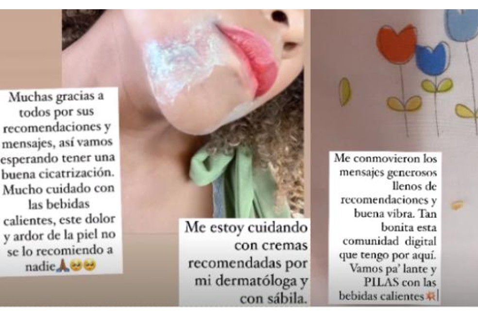 Mábel Lara se quemó el rostro con bebida caliente La presentadora Mábel Lara sorprendió a sus seguidores en las redes sociales, tras contar que en los últimos días sufrió un accidente casero en el que se quemó su cara. En su cuenta de Instagram la presentadora publicó una foto de la quemadura en su rostro, junto con un mensaje que decía: “Así como cuando se te estalla un termo con café hirviendo en la cara. He llorado mis ojos”.