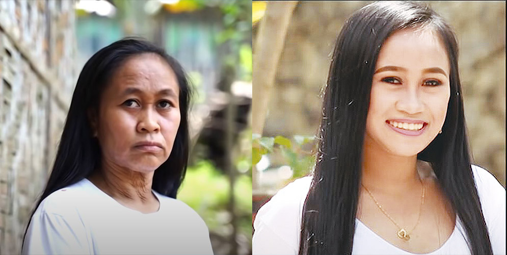 Raizel tiene 16 años, pero por una enfermedad parece de 60 2 Raizel tiene 16 años, pero por una enfermedad parece de 60 Raizel Calago es una filipina de 16 años, quien hace dos años comenzó a ver una rara transformación en su rostro y en cuerpo, todo por culpa de una extraña enfermedad que la ha perturbado.