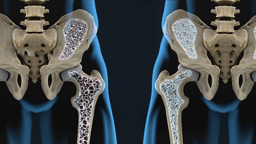 La osteoporosis afecta alrededor de 200 millones de personas en el mundo 2 La osteoporosis afecta alrededor de 200 millones de personas en el mundo En el marco del Día Mundial de la Osteoporosis, este 20 de octubre, la Asociación Colombiana de Osteoporosis y Metabolismo Mineral, ACOMM hizo un llamado a toda la población a que se fomente en los hogares hábitos saludables y se recurra al especialista a tiempo para evitar una fractura por osteoporosis.