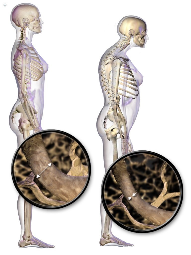 Todo lo que debe saber sobre la osteoporosis Por increíble que parezca, la osteoporosis puede llegar a ser una enfermedad que cause la muerte, pues quien la padece luego de sufrir una fractura a causa de la fragilidad de sus huesos, se enfrenta a un riesgo de fallecimiento entre el 15 y 30%, de acuerdo con estudios.