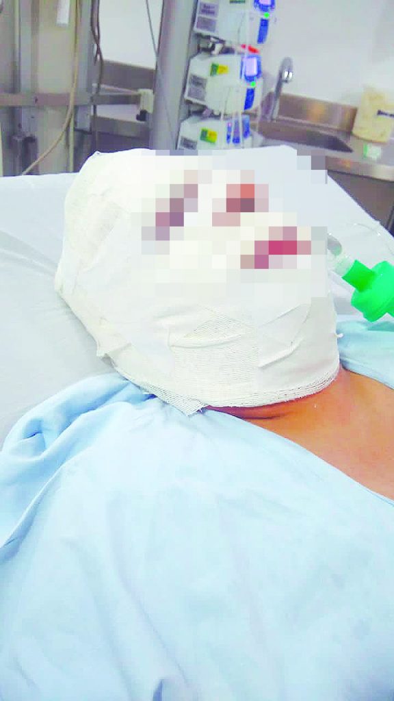 Pasajera le arrojó ácido y le quemó la cara a taxista 2 Pasajera le arrojó ácido y le quemó la cara a taxista Édison Rojas (27 años), un conductor de taxi desde hace unos 9 años, jamás imaginó que en la madrugada del pasado domingo su vida fuera a cambiar del cielo a la tierra, y que hoy estaría en un delicado estado de salud en un centro médico tras haber sido atacado por una pasajera con ácido en su rostro.