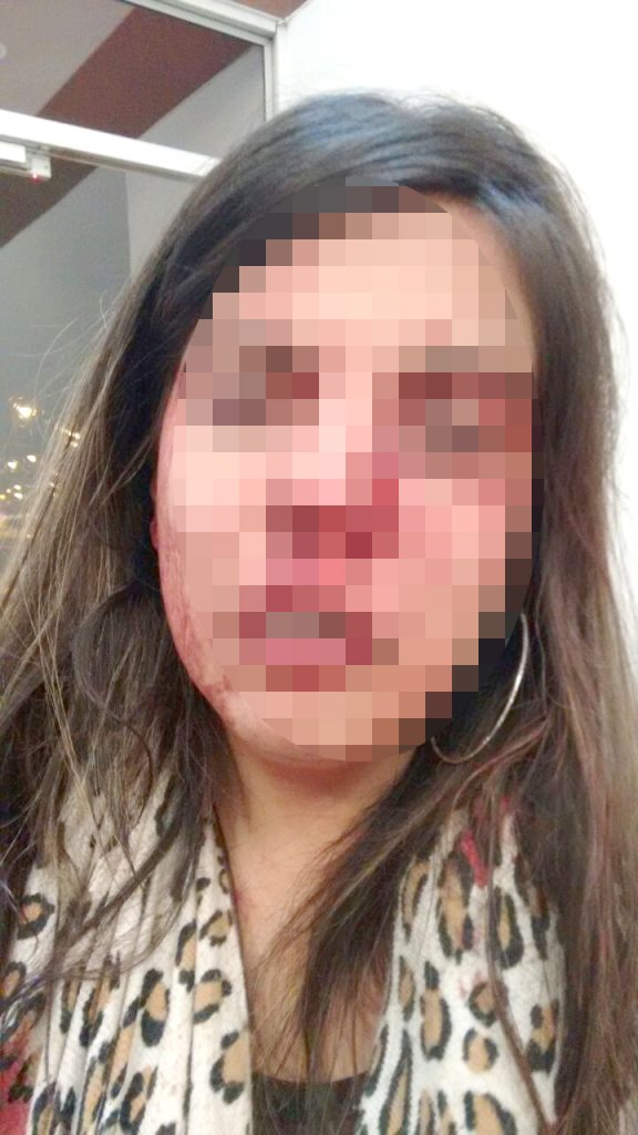 Resultó condenada Leily, víctima de terribles agresiones 2 Resultó condenada Leily, víctima de terribles agresiones Seis años tuvieron que pasar para que el caso de violencia de género del que fue víctima Leily Vanegas Gómez, una joven psicóloga de 29 años, tuviera sus primeras sentencias. Mientras que el presunto agresor de Leily (su expareja, Santiago Garavito) fue condenado a 62 meses de cárcel, el giro inesperado que dieron los jueces en las últimas horas sorprendió a la muchacha -y a la ciudadanía-. Un juez la condenó a ella a 4 años de prisión por una denuncia que interpuso el mismo hombre que por poco le desfigura su rostro a golpes.