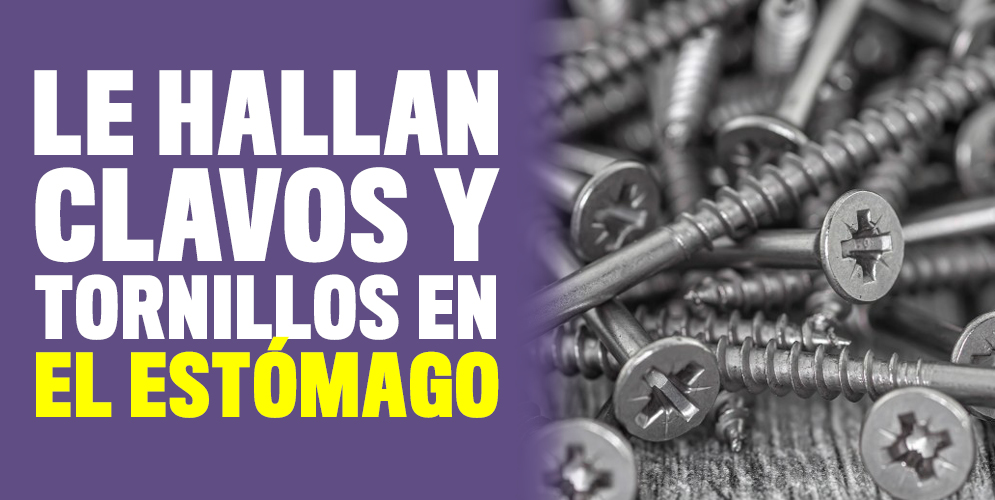 ¡Insólito! Se comió tornillos y clavos cuando dejó el alcohol Médicos lituanos informaron en los últimos días que encontraron un kilogramo de clavos y&nbsp;tornillos&nbsp;dentro del estómago de un hombre que empezó a engullir objetos metálicos tras dejar de beber alcohol.