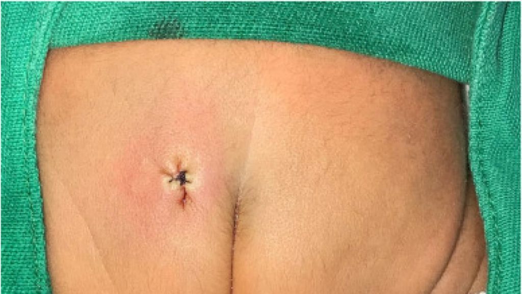 Bebé prematuro nació con una extraña malformación 1 Bebé prematuro nació con una extraña malformación Un raro caso médico se presentó en el hospital infantil Albert Sabin de Fortaleza (Brasil). Resulta que un bebé prematuro (35 meses) nació con una rara malformación en su cuerpo.