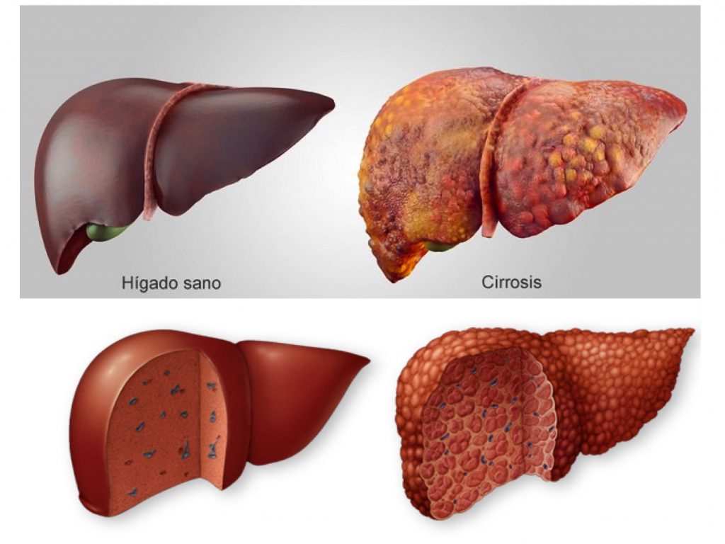Transplante de hígado, el más común en pandemia Con la pandemia del COVID se desataron un montón de problemáticas de salud pública que están directa o indirectamente relacionadas con el virus.