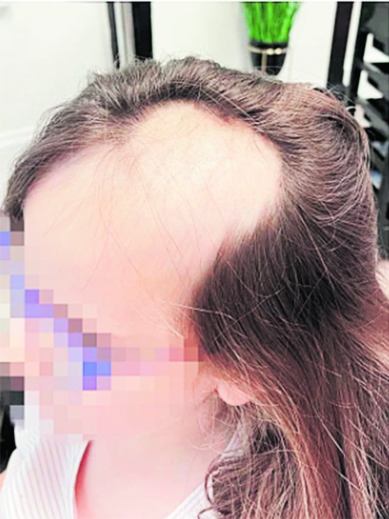 Haciendo un pastel con su abuela perdió su cabello En Reino Unido una niña de cinco años se encontraba con su abuela preparando un pastel, sin duda un momento muy especial para la familia, pero tristemente este recuerdo se vio marcado por un incidente que dejó a todos en la familia en shock y quizás a la pequeña sin ganas de volver a entrar a la cocina.