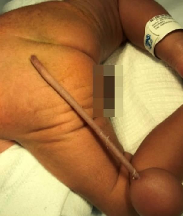 Bebé prematuro nació con una extraña malformación 2 Bebé prematuro nació con una extraña malformación Un raro caso médico se presentó en el hospital infantil Albert Sabin de Fortaleza (Brasil). Resulta que un bebé prematuro (35 meses) nació con una rara malformación en su cuerpo.