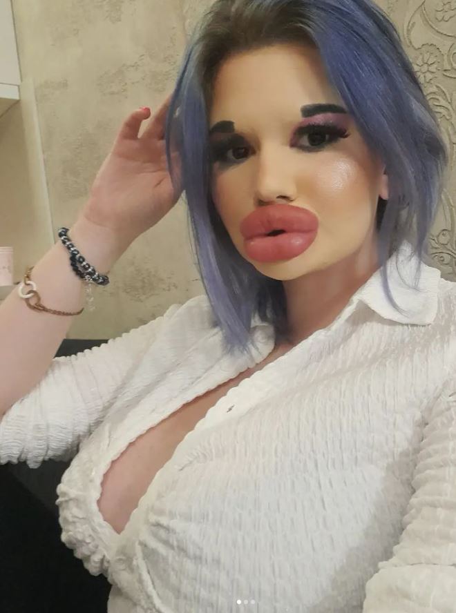 Se ha hecho 26 operaciones en los labios... ¡ya va por más! 2 Se ha hecho 26 operaciones en los labios... ¡ya va por más! Se ha hecho 26 operaciones en los labios y tiene 24 años, cifras que hablan claramente de la obsesión que la búlgara Andrea Emilova Ivanova tiene por las cirugías plásticas. Dice tener los labios más grandes del mundo y las fotos que publica en sus redes lo comprueban.