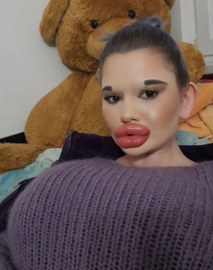 Se ha hecho 26 operaciones en los labios... ¡ya va por más! 3 Se ha hecho 26 operaciones en los labios... ¡ya va por más! Se ha hecho 26 operaciones en los labios y tiene 24 años, cifras que hablan claramente de la obsesión que la búlgara Andrea Emilova Ivanova tiene por las cirugías plásticas. Dice tener los labios más grandes del mundo y las fotos que publica en sus redes lo comprueban.