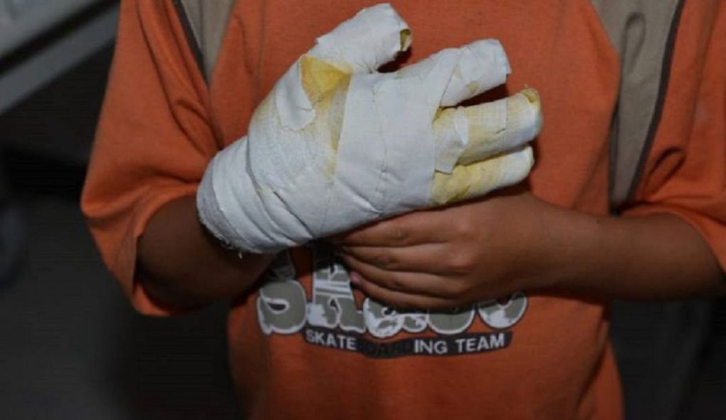 Totes, los que más causan quemaduras en los menores 1 Totes, los que más causan quemaduras en los menores El Instituto Nacional de Salud reportó este lunes que en medio de las festividades de fin de año en Colombia el número de personas quemadas con pólvora, llegó a 346 lesionados, de los cuales 129 han sido menores de edad.