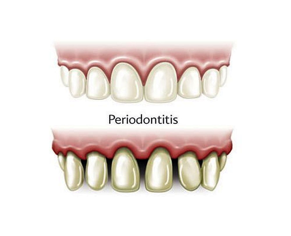 VIGILE LA SALUD DE SUS ENCÍAS 3 VIGILE LA SALUD DE SUS ENCÍAS La relación entre la salud bucodental, especialmente la enfermedad periodontal, y las enfermedades cardiovasculares han recibido una atención cada vez mayor en las últimas dos décadas.