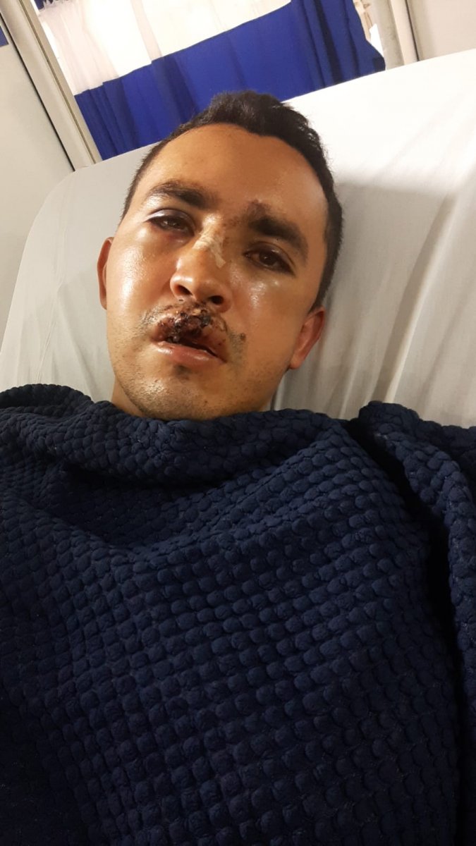 El drama de Michael por malditos ladrones en ciclorruta de Fontibón 2 El drama de Michael por malditos ladrones en ciclorruta de Fontibón La violencia en medio de los atracos en Bogotá cada vez es más insoportable. Esta semana conocimos el caso de un joven trabajador y padre de familia de 31 años, quien hoy está postrado en la cama de un hospital tras ser atacado por dos ladrones. Estos maleantes no contentos con quitarle sus pertenencias, entre ellas su bicicleta, le dejaron graves traumas en el rostro y la cabeza.