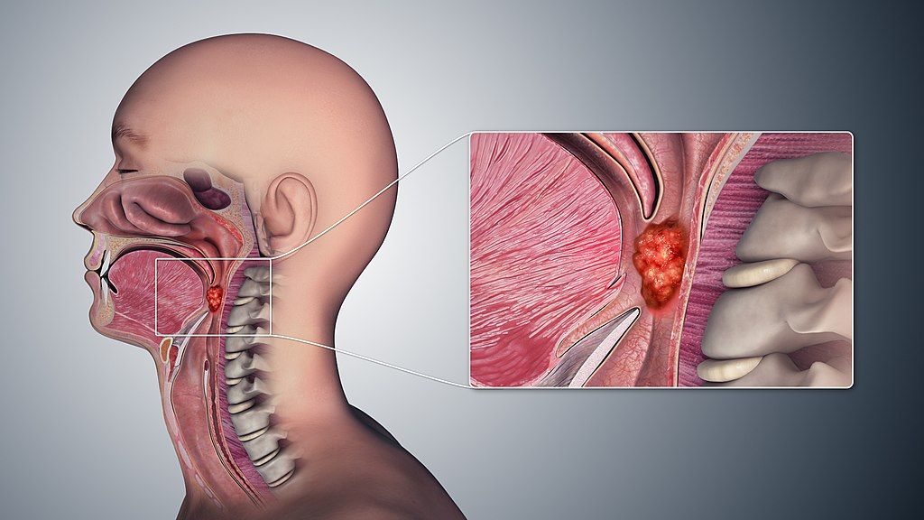Pilas con el cáncer de cuello 1 Pilas con el cáncer de cuello Karen* tiene tan solo 40 años, dos hijos y una profesión exitosa.