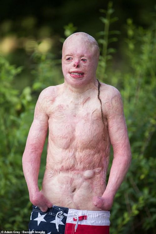 Johnny Quinn, el niño que sobrevivió a las llamas y al matoneo 2 Johnny Quinn, el niño que sobrevivió a las llamas y al matoneo Durante años, Johnny Quinn creció sintiéndose como un monstruo por cuenta de su apariencia física, pues con tan solo 4 años sobrevivió a un incendio en su natal Tennessee (Estados Unidos). De acuerdo con el relato de su familia, accidentalmente su mascota hizo caer una vela, provocando las incontrolables llamas.