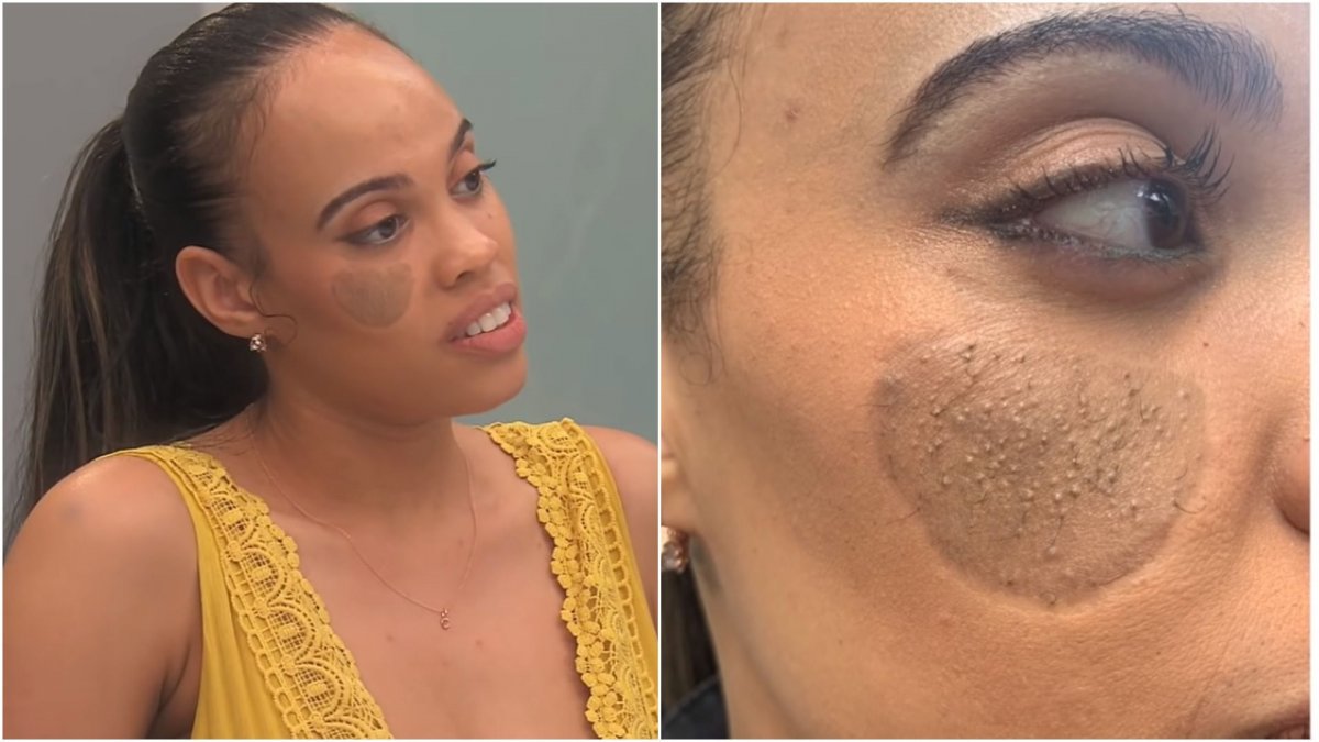 ¡Insólito caso! Le creció vello púbico en su rostro Crystal Coombs es una mujer a la que le creció vello púbico en el rostro. Su caso se hizo famoso al salir en el reconocido programa gringo llamado 'Botched', del canal E! Entertainment, donde los especialistas en cirugía plástica buscan corregir operaciones estéticas con resultados desfavorables.