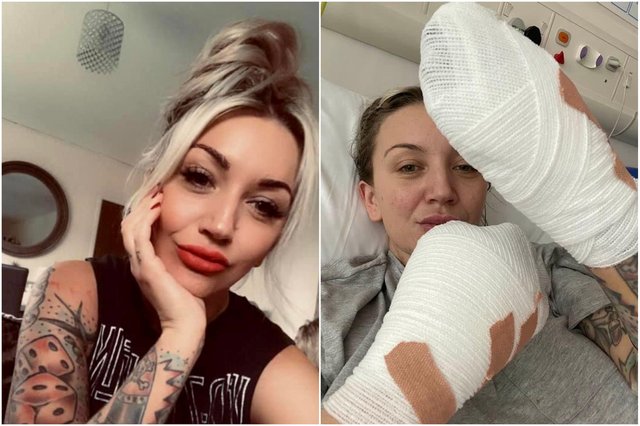 Sadie Kemp, la mujer que perdió todos los dedos de sus manos tras una infección Una joven en Inglaterra, llamada Sadie Kemp, sufrió de una infección y su vida cambió drásticamente cuando le tuvieron que amputar todos los dedos de sus manos.