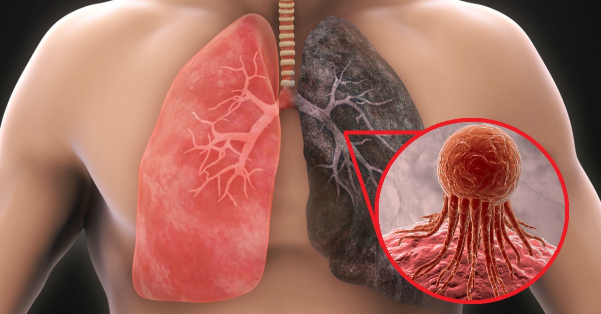 Cáncer de pulmón, otro enemigo silencioso 7 Cáncer de pulmón, otro enemigo silencioso Una de esas enfermedades silenciosas es el cáncer de pulmón; cuando se quiere detectar ya se ha manifestado. Luego, se siente hasta en la respiración.