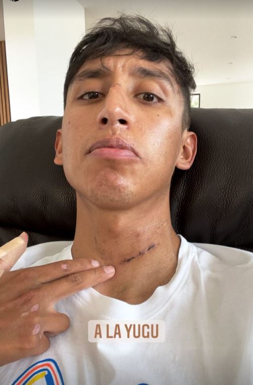 La impactante foto de Egan 1 La impactante foto de Egan Nuestro Egan Bernal hizo públicas en las últimas horas las cicatrices que le quedaron tras ser intervenido quirúrgicamente, después de haber colisionado contra un bus a 65 kilómetros mientras practicaba una prueba contrarreloj en carreteras de Cundinamarca, hecho que sucedió el pasado 24 de enero.
