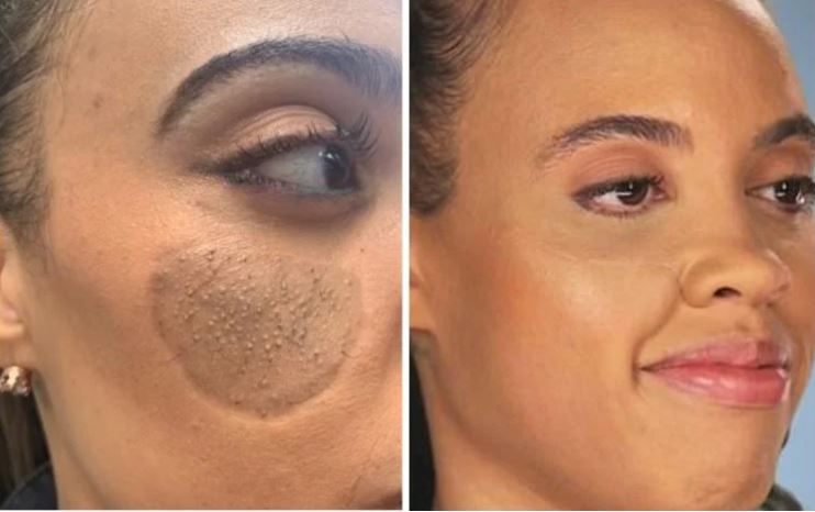 ¡Insólito caso! Le creció vello púbico en su rostro Crystal Coombs es una mujer a la que le creció vello púbico en el rostro. Su caso se hizo famoso al salir en el reconocido programa gringo llamado 'Botched', del canal E! Entertainment, donde los especialistas en cirugía plástica buscan corregir operaciones estéticas con resultados desfavorables.