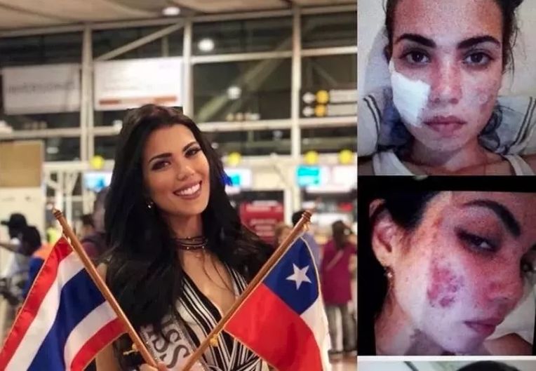 Miss Universo cuenta que una mala cirugía le arruinó el rostro La modelo, periodista y concursante de Miss Universo 2018, Andrea Díaz, contó cómo fue que por poco pierde el sueño de ser reina de belleza, pues debido a un procedimiento estético su rostro quedó con quemaduras muy notables.