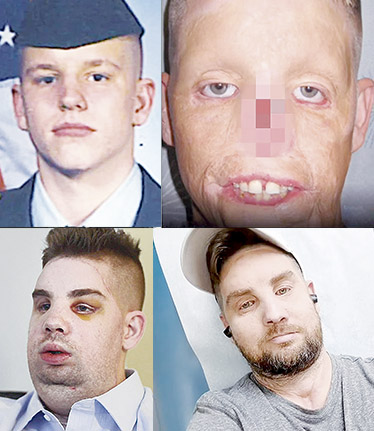 Así fue su cambio luego de un transplante de cara 1 Así fue su cambio luego de un transplante de cara Hace 11 años Mitch Hunter, un exsoldado estadounidense, vivió el peor momento de su vida cuando se estrelló en su auto con una torre eléctrica de 10 mil voltios, sufriendo graves quemaduras y la desfiguración de su rostro.