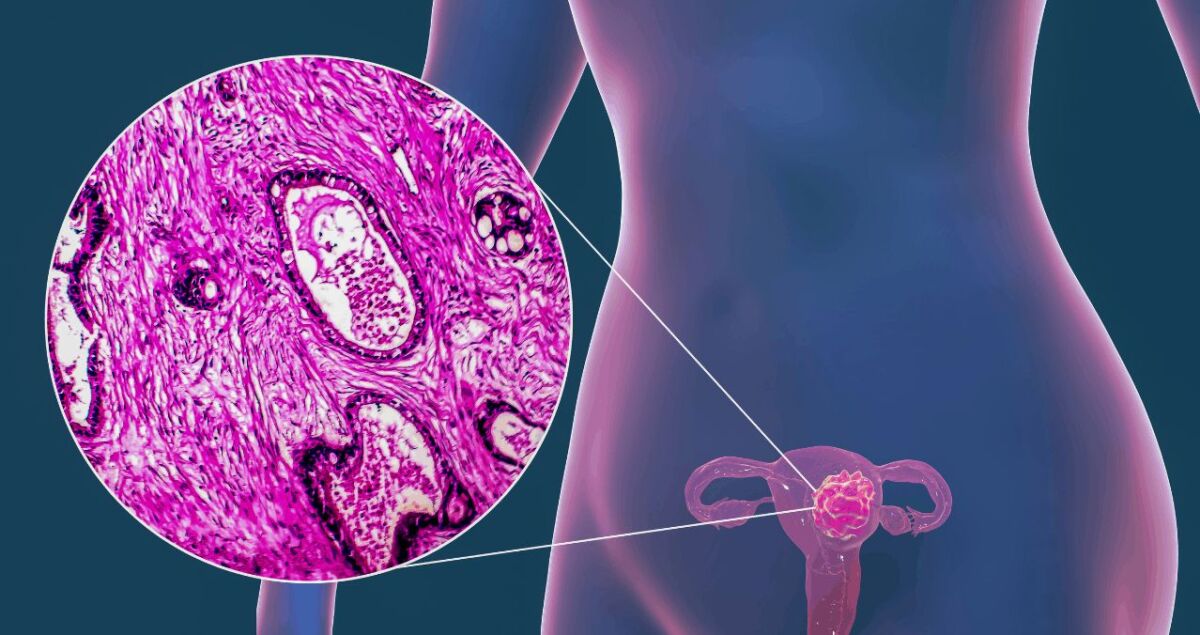 Cada día fallecen 7 mujeres en Colombia por causa del cáncer de cuello uterino 2 Cada día fallecen 7 mujeres en Colombia por causa del cáncer de cuello uterino Este sábado se celebra en el mundo el día del cáncer del cuello uterino (CCU), condición que se estima, cobra diariamente la vida de 7 mujeres en Colombia, según el Observatorio Nacional de Cáncer del Ministerio de Salud.
