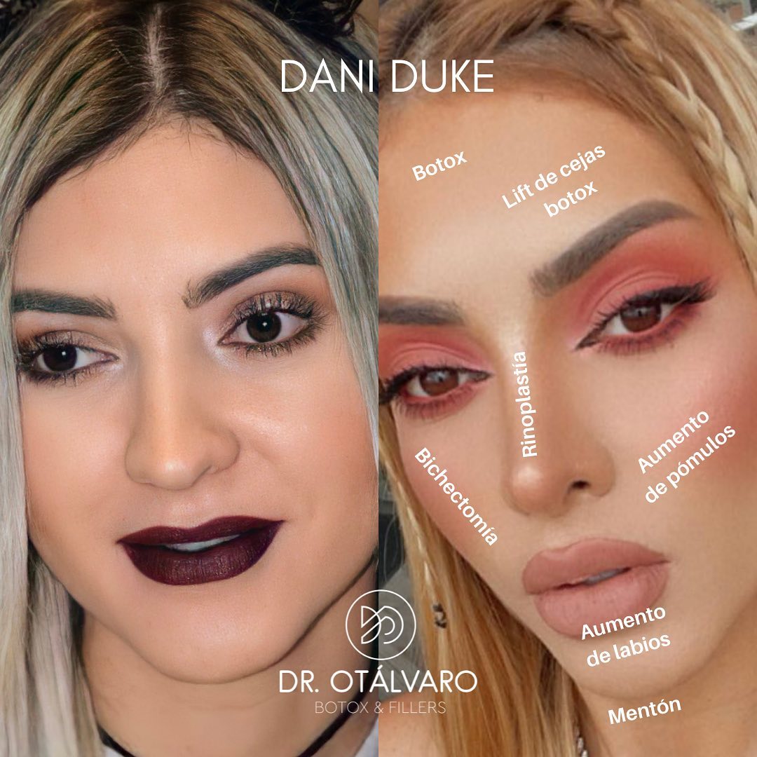 Médico boleteó los retoquitos de varias famosas... ¡vea el antes y el ahora! Hay famosas que uno sabe que cualquier retoque tienen, pues las fotos del antes y después las delatan.