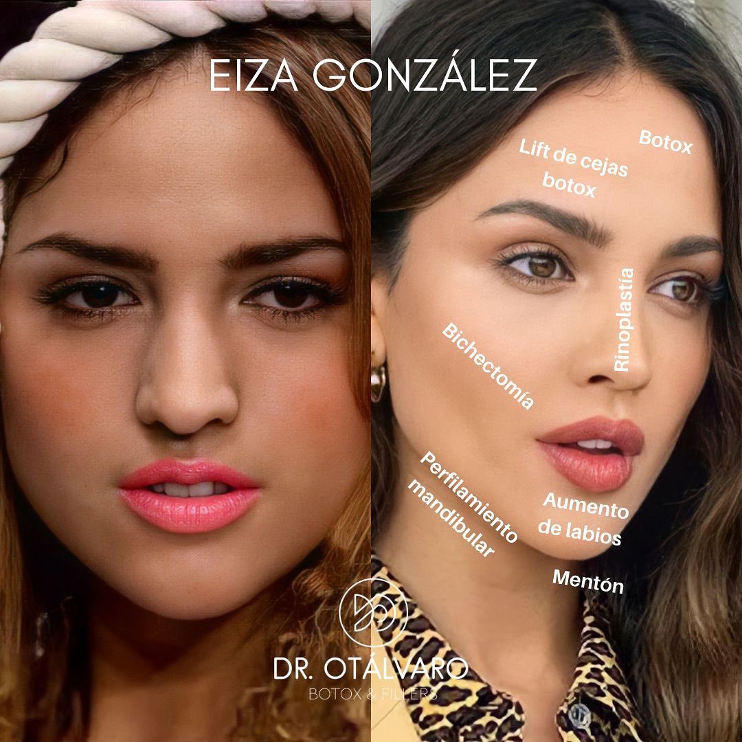Médico boleteó los retoquitos de varias famosas... ¡vea el antes y el ahora! Hay famosas que uno sabe que cualquier retoque tienen, pues las fotos del antes y después las delatan.