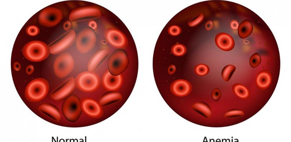 ¡A SUBIR LOS GLÓBULOS ROJOS! 2 ¡A SUBIR LOS GLÓBULOS ROJOS! La anemia es una afección por la cual el cuerpo no produce suficientes glóbulos rojos sanos, que son los que les suministran el oxígeno a los tejidos corporales. La anemia por deficiencia de hierro es la más común.