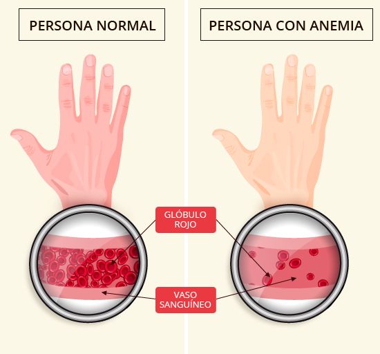 ¡A SUBIR LOS GLÓBULOS ROJOS! 3 ¡A SUBIR LOS GLÓBULOS ROJOS! La anemia es una afección por la cual el cuerpo no produce suficientes glóbulos rojos sanos, que son los que les suministran el oxígeno a los tejidos corporales. La anemia por deficiencia de hierro es la más común.