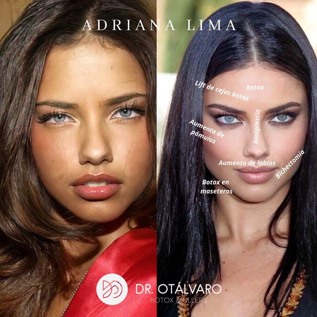 Médico boleteó los retoquitos de varias famosas... ¡vea el antes y el ahora! Hay famosas que uno sabe que cualquier retoque tienen, pues las fotos del antes y después las delatan.