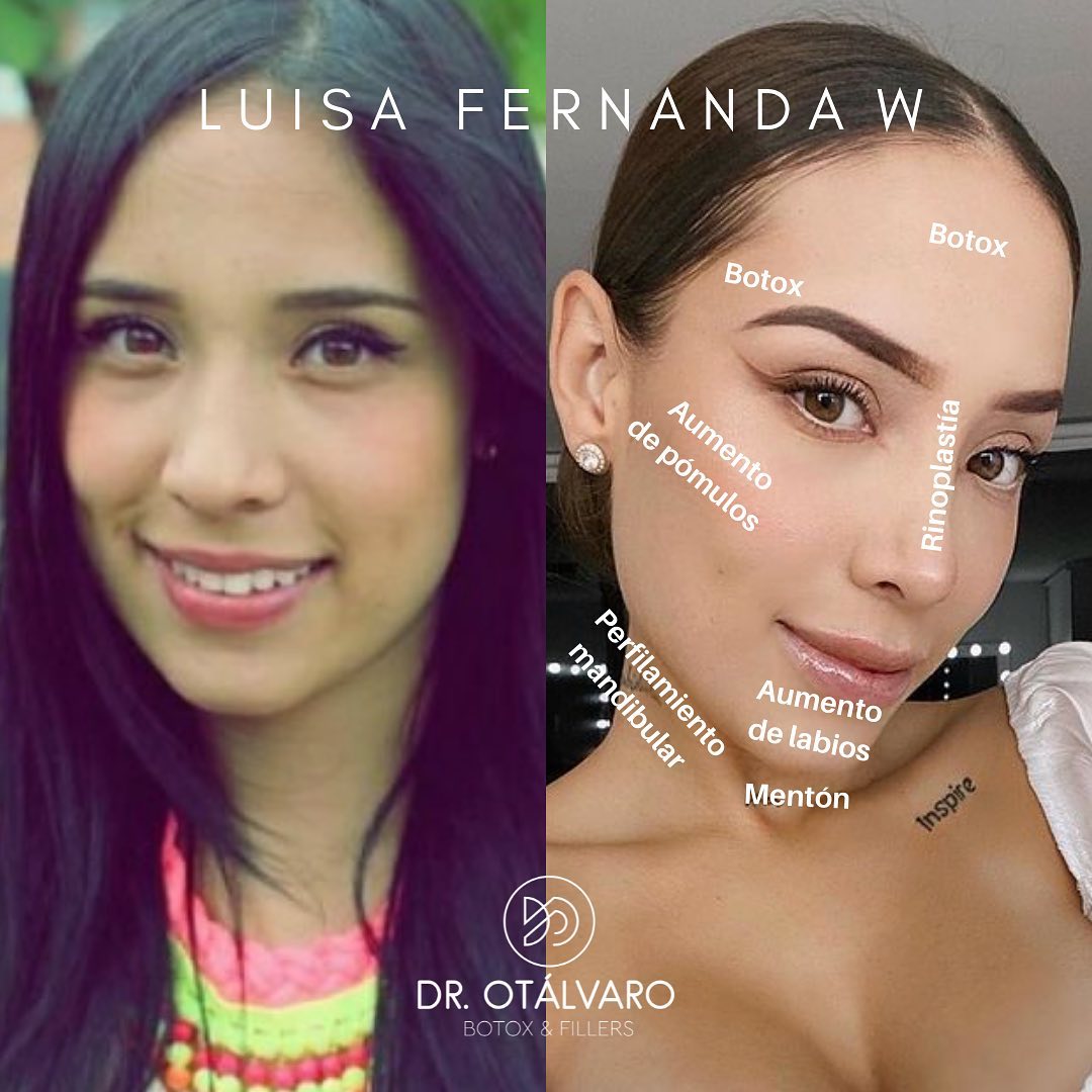 Médico boleteó los retoquitos de varias famosas... ¡vea el antes y el ahora! Hay famosas que uno sabe que cualquier retoque tienen, pues las fotos del antes y después las delatan.