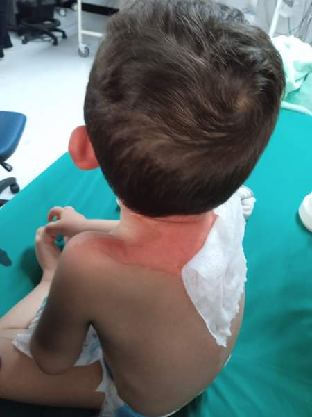 Bebé resultó quemado dentro de un jardín en Fontibón Madre denunció que su bebé de 23 meses, en un descuido por parte de una maestra, resultó quemado con agua hirviendo dentro de un jardín infantil del distrito, en la localidad de Fontibón.