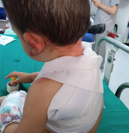 Bebé resultó quemado dentro de un jardín en Fontibón Madre denunció que su bebé de 23 meses, en un descuido por parte de una maestra, resultó quemado con agua hirviendo dentro de un jardín infantil del distrito, en la localidad de Fontibón.