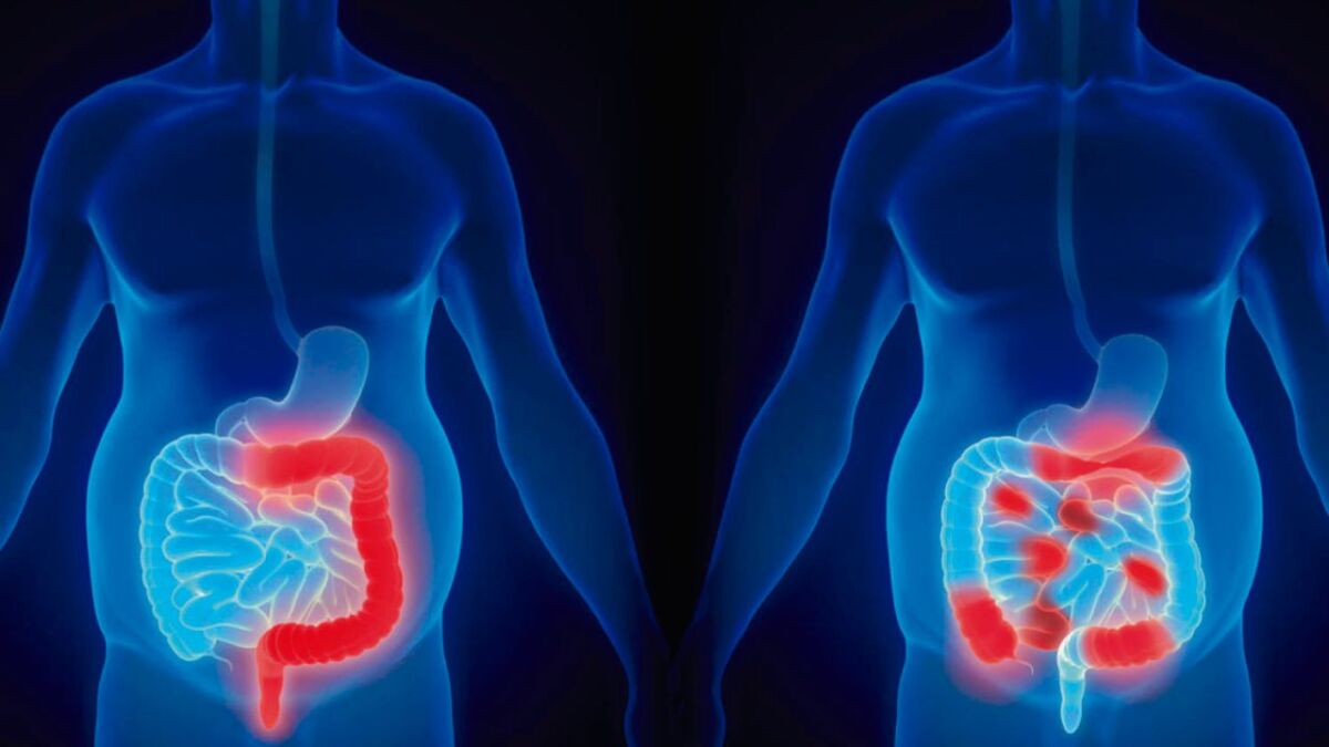 Amebiasis, ‘golpe’ al intestino La amebiasis es una infección intestinal. Es causada por el parásito microscópico Entamoeba histolytica, que puede vivir en el intestino grueso (colon) sin causarle daño.