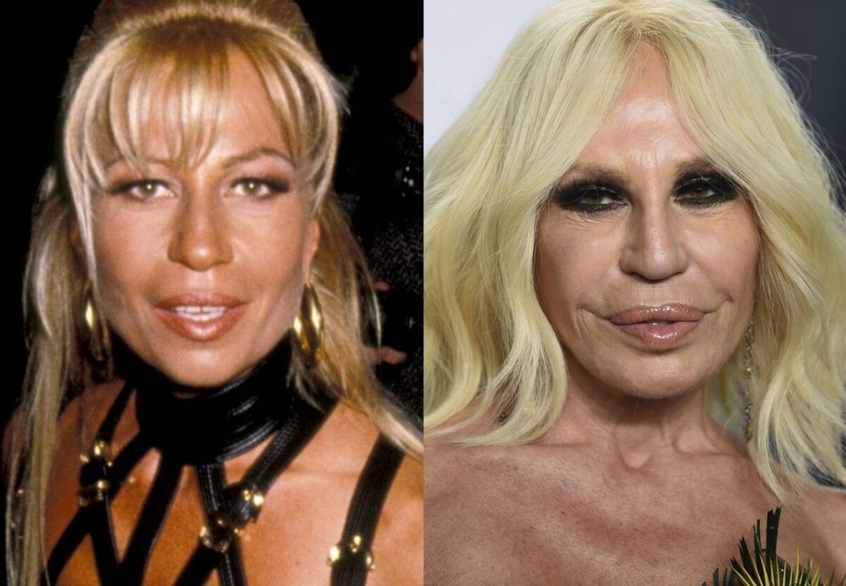 Famosos que han abusado de la cirugías y el bótox 3 Famosos que han abusado de la cirugías y el bótox No hay que tener cinco dedos de frente para notar que Madonna se hizo retoques en su rostro. Más allá de que le parezcan bien o mal, esto causó polémica en redes sociales, pues se le evidencian bastante el cambio, tanto que no parece que fuera la cantante de 63 años. Muchos dicen que su adicción a la cirugía plástica y al bótox la está deformando, al punto de dejarla irreconosible.