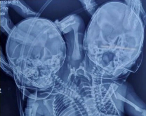 Mujer que esperaba gemelos tuvo un solo bebé con dos cabezas y tres brazos 1 Mujer que esperaba gemelos tuvo un solo bebé con dos cabezas y tres brazos El nacimiento de un bebé causó sorpresa en los médicos y los padres al darse cuenta que tenía una cabeza y un brazo de más. El hecho es conocido científicamente como parapagus dicefálico, una condición en la que dos cráneos separados comparten un mismo torso.