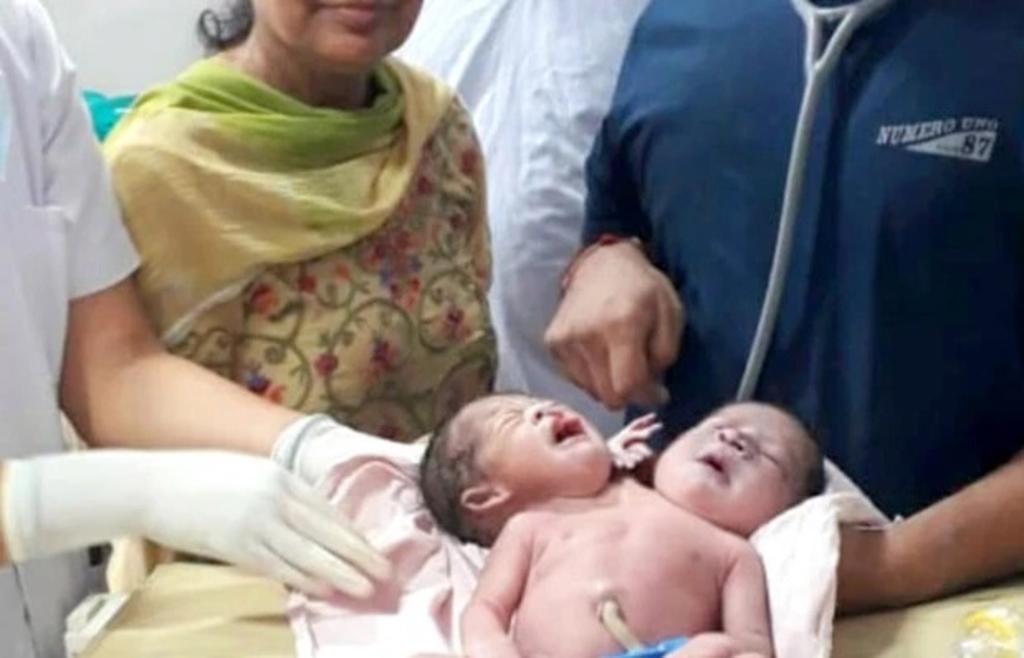 Mujer que esperaba gemelos tuvo un solo bebé con dos cabezas y tres brazos 4 Mujer que esperaba gemelos tuvo un solo bebé con dos cabezas y tres brazos El nacimiento de un bebé causó sorpresa en los médicos y los padres al darse cuenta que tenía una cabeza y un brazo de más. El hecho es conocido científicamente como parapagus dicefálico, una condición en la que dos cráneos separados comparten un mismo torso.