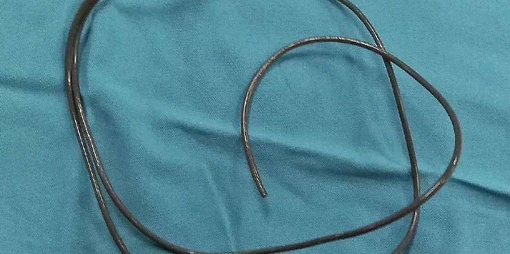 ¡Impactante! Médicos le sacaron cable de los genitales a un hombre Un hombre de 34 años que presentaba dolor en sus genitales y que no podía orinar, decidió asistir de urgencias a un hospital para que le ayudaran, sin embargo, los médicos se llevaron un gran sorpresa al ver lo que el hombre tenía.