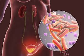 La cistitis puede generar problemas en los riñones Cistitis es el término médico para definir la inflamación de la vejiga. La mayoría de las veces la inflamación es causada por una infección bacteriana y se llama infección urinaria. Una infección en la vejiga puede ser dolorosa y molesta, y puede convertirse en un problema de salud grave si la infección se disemina a los riñones.