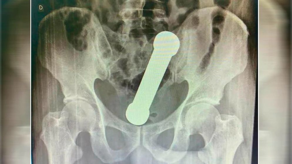 A hombre le hallaron una pesa en el recto 2 A hombre le hallaron una pesa en el recto Un fuerte dolor de estómago, llevó a un hombre a ir de urgencias a un centro asistencial para que un profesional lo atendiera y le medicara algo para calmar la dolencia. Sin embargo, al hacerle estudios, le hallaron una pesa en el recto.