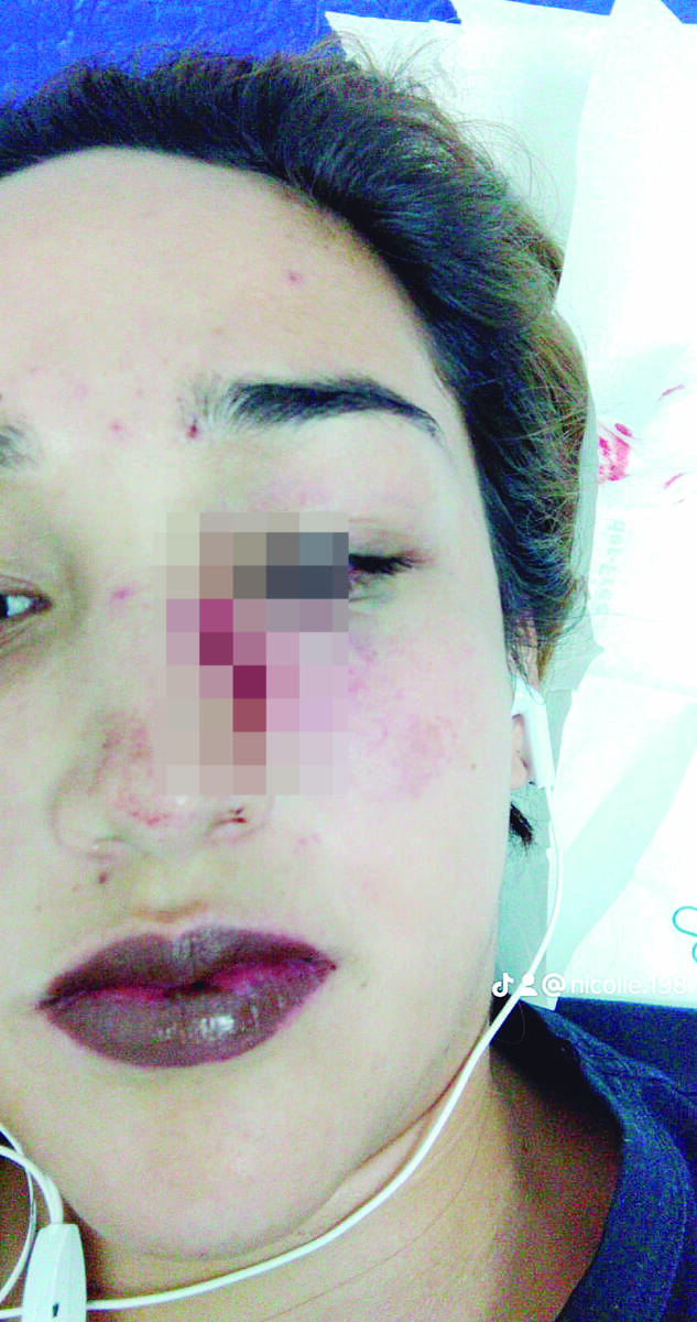 Mujer denuncia brutales agresiones por parte de su expareja en Rafael Uribe 2 Mujer denuncia brutales agresiones por parte de su expareja en Rafael Uribe Desde el año 2016 Nicolle Dayanne González Rodríguez ha sido víctima de brutales actos de violencia de parte del que hasta hace unos meses era su pareja sentimental. Q’HUBO habló con la mujer, que tras años de abuso y maltrato decidió exponer su caso para exigir justicia y animar a otras víctimas de violencia de género a denunciar.
