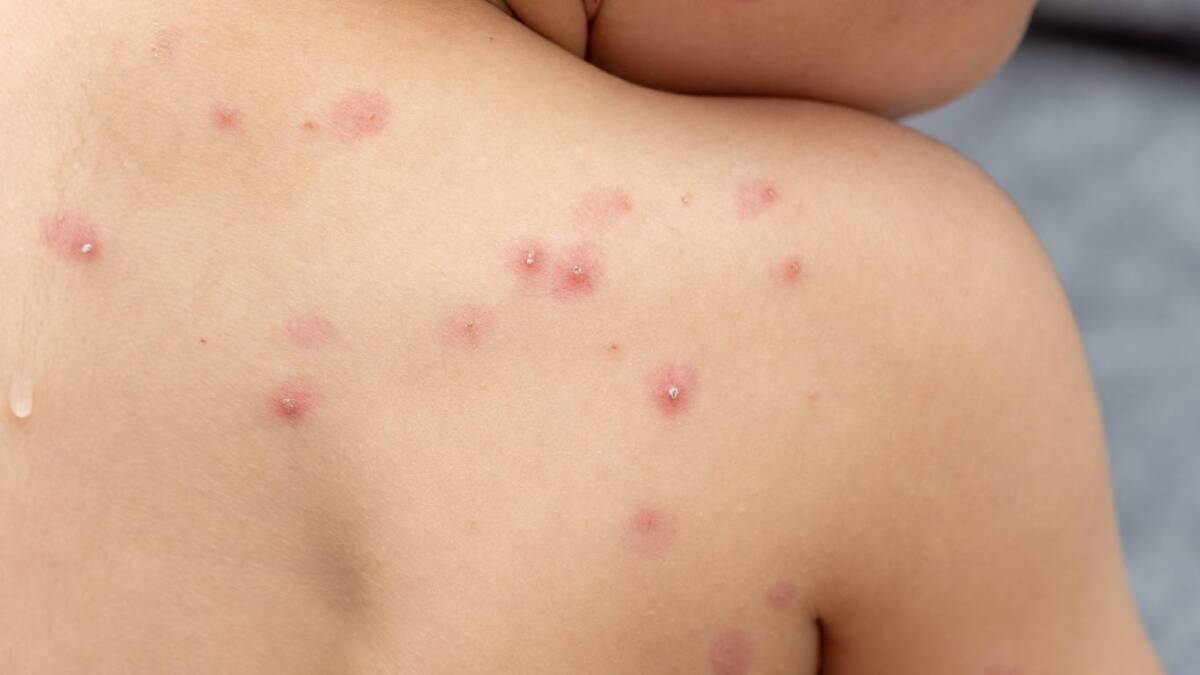 OMS aún desconoce si podrá contener por completo la viruela del mono La Oficina Regional para Europa de la Organización Mundial de la Salud (OMS) ha descartado tener que tomar medidas similares a las tomadas durante la pandemia de COVID-19 para atajar la viruela del mono, pero ha reconocido que aún se desconoce si se podrá "contener su propagación por completo".