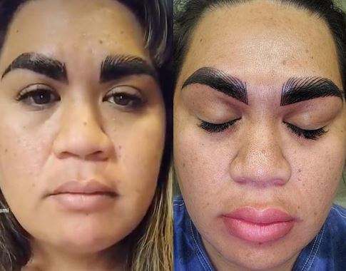Mujer se mandó a hacer tratamiento en cejas y el resultado fue desastroso 2 Mujer se mandó a hacer tratamiento en cejas y el resultado fue desastroso Cada día son más las personas que les gusta someterse a tratamientos de belleza, lo cual no está nada mal, puesto que preocuparse por uno mismo y querer lucir mejor, hace parte de las decisiones que cada persona toma. Tristemente hay quienes no dan con buenas manos para hacerse algún procedimiento y terminan con resultados nefastos como el de una mujer en Estados Unidos.