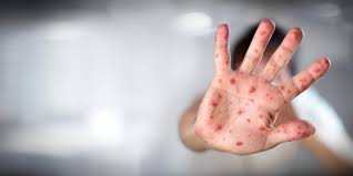 Se confirman dos nuevos casos de viruela del mono en Bogotá 1 Se confirman dos nuevos casos de viruela del mono en Bogotá Éste sábado fueron confirmados la existencia en el país de dos nuevos casos de la llamada viruela del mono o viruela símica como científicamente se le conoce. De acuerdo al Ministerio de Salud y el Instituto Nacional de Salud, los reportes tienen origen en la capital del país.