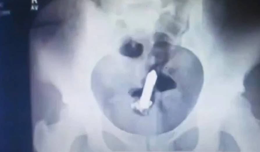 A mujer se le quedó atrapado su juguetico sexual en el cuerpo 1 A mujer se le quedó atrapado su juguetico sexual en el cuerpo Una mujer estadounidense que es tiktoker, pasó por un bochornoso momento cuando tuvo que acudir al hospital para que médicos le retiraran un juguete sexual que se le quedó atrapado dentro de su recto.