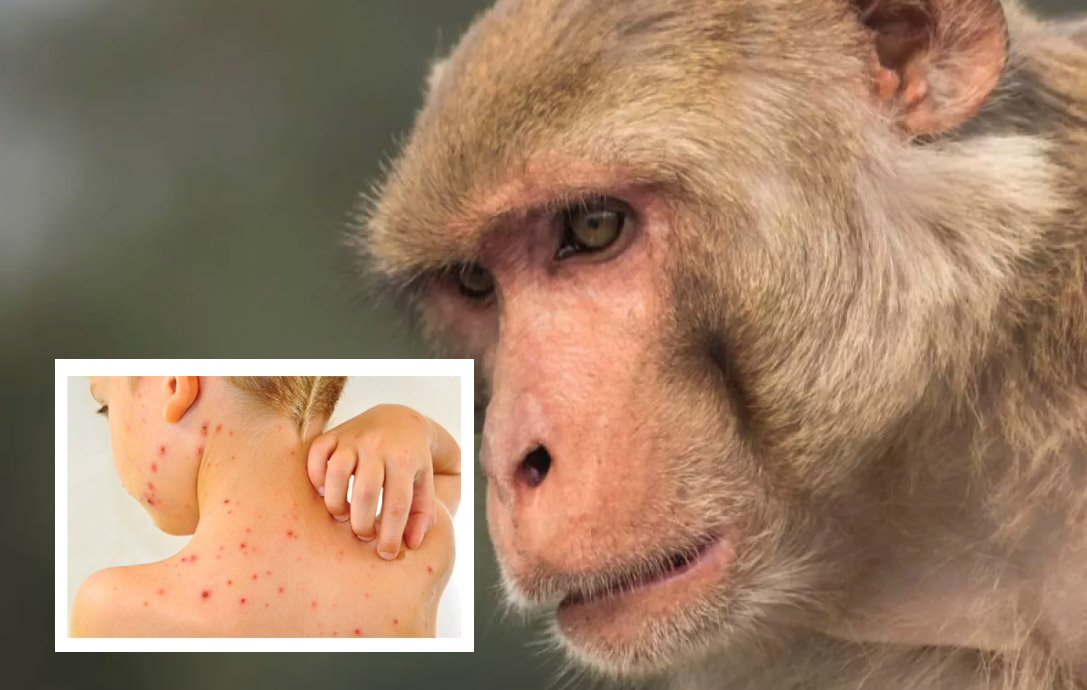 En Colombia no se han confirmado casos de viruela del mono 8 En Colombia no se han confirmado casos de viruela del mono El Instituto Nacional de Salud descartó que por el momento se hayan detectado casos de viruela del mono en Colombia.