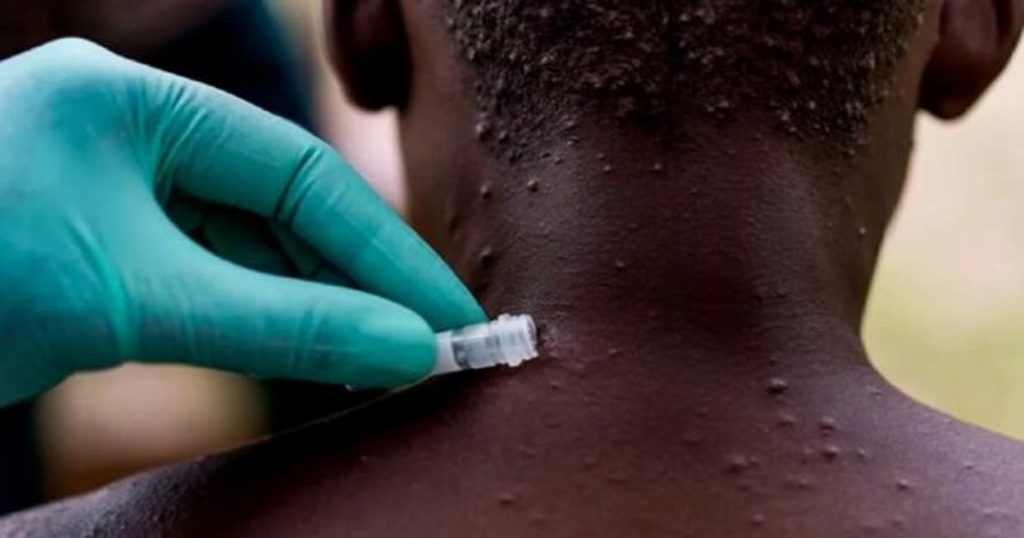 OMS aún desconoce si podrá contener por completo la viruela del mono La Oficina Regional para Europa de la Organización Mundial de la Salud (OMS) ha descartado tener que tomar medidas similares a las tomadas durante la pandemia de COVID-19 para atajar la viruela del mono, pero ha reconocido que aún se desconoce si se podrá "contener su propagación por completo".