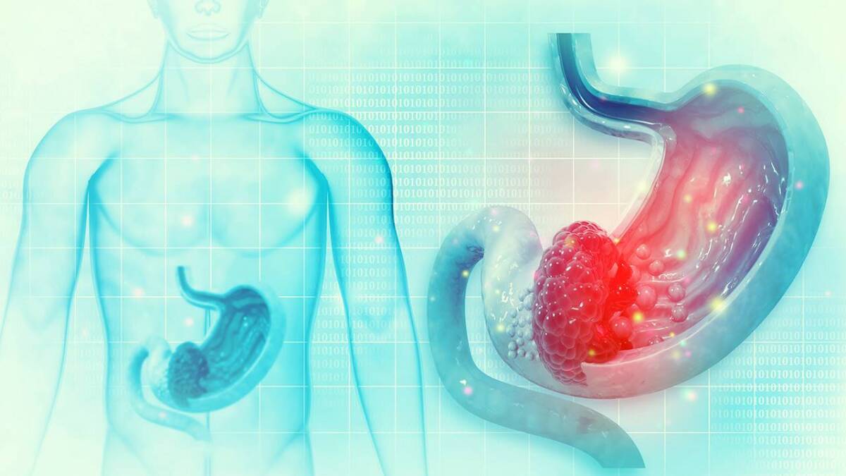 La gastritis es un dolor que 'quema' 1 La gastritis es un dolor que 'quema' La gastritis es la inflamación aguda o crónica de la mucosa que recubre las paredes del estómago. Puede estar producida por diversos agentes, como la ingesta de ciertos medicamentos o la infección por la bacteria Helicobacter pylori.