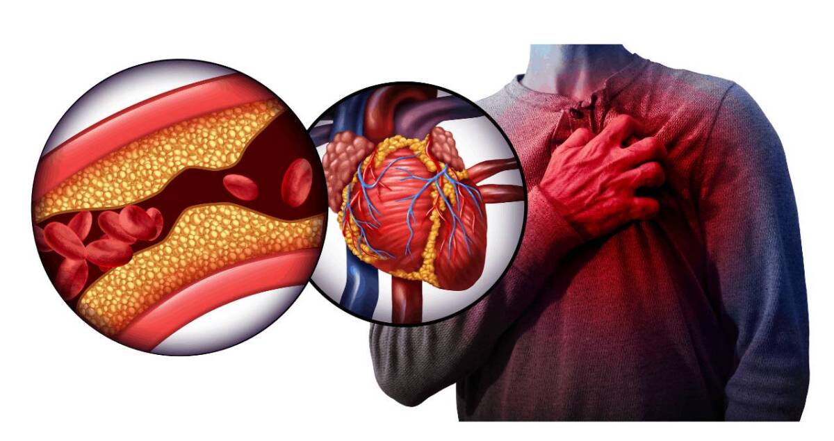 Esté alerta de su corazón 1 Esté alerta de su corazón El infarto de miocardio aparece cuando se produce un daño en el músculo del corazón, en el tejido cardíaco, como consecuencia de un déficit en la llegada de oxígeno o de sangre.